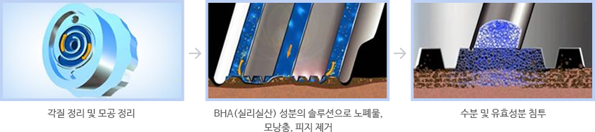아쿠아필 치료순서: 각질 정리 및 모공 정리, BHA(실리실산) 성분의 솔루션으로 노폐물·모낭충·피지 제거, 수분 및 유효성분 침투