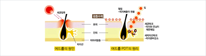 여드름 클리닉